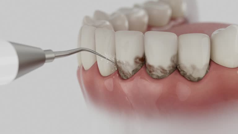 Reliable Dental Implants contractor in Milford, IL by Smile Center Dentistry